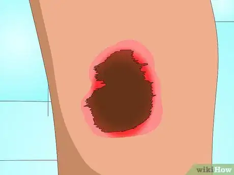 Image intitulée Get Rid of Acne Scabs Fast Step 12
