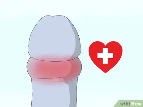 Image intitulée Pull Your Foreskin Back Without Pain Step 5