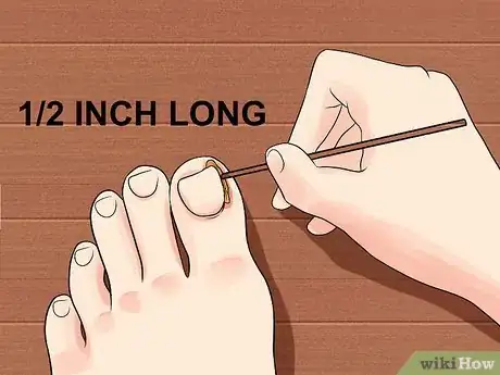 Image intitulée Heal an Ingrown Toenail Step 4