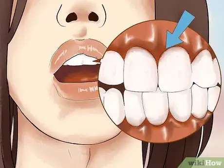 Image intitulée Heal Mouth Inflammation Step 10