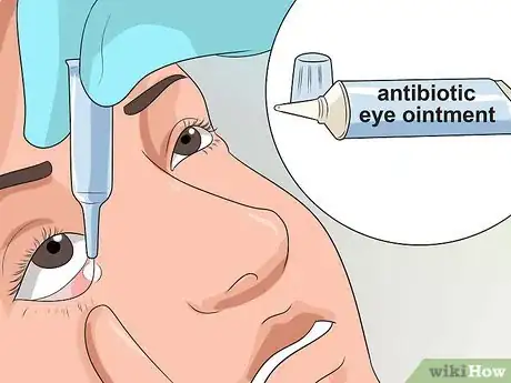 Image intitulée Get Rid of Pink Eye Fast Step 10