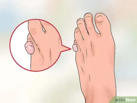 Image intitulée Heal Blisters Step 15