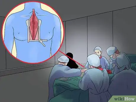 Image intitulée Remove a Thymoma Step 8