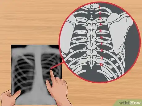 Image intitulée Read a Chest X Ray Step 4