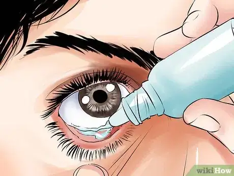 Image intitulée Heal a Scratched Cornea Step 15