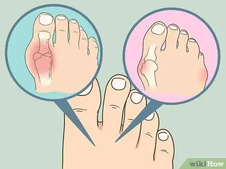 Image intitulée Soak an Ingrown Toenail Step 10