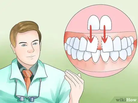 Image intitulée Determine if You Need Braces Step 15