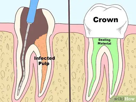 Image intitulée Keep a Cavity from Getting Worse Step 12