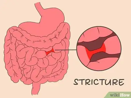 Image intitulée Treat Diverticulitis Step 12