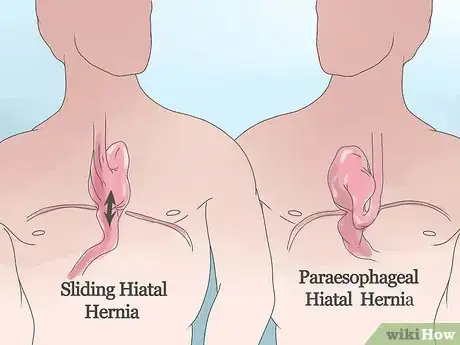 Image intitulée Know if You Have a Hiatal Hernia Step 7