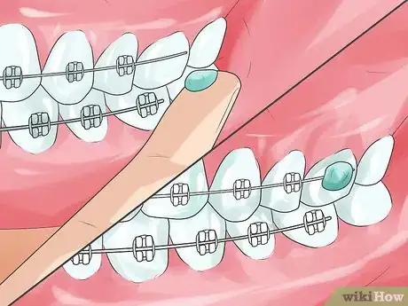 Image intitulée Handle Poking Wires on Braces Step 4