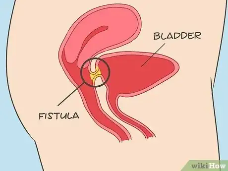 Image intitulée Treat Diverticulitis Step 11