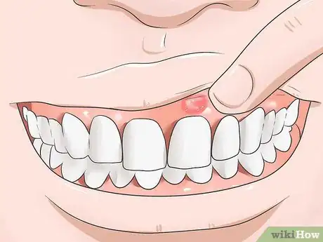 Image intitulée Reduce Gum Swelling Step 1