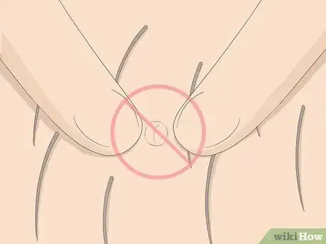 Image intitulée Get Rid of Ingrown Pubic Hair Step 2