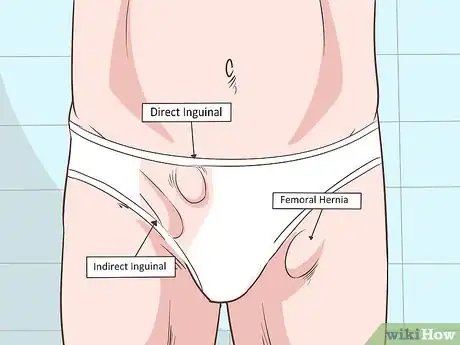 Image intitulée Recognize a Scrotal Hernia Step 4