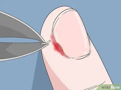 Image intitulée Treat a Hangnail Infection Step 2