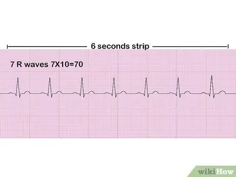 Image intitulée Read an EKG Step 7