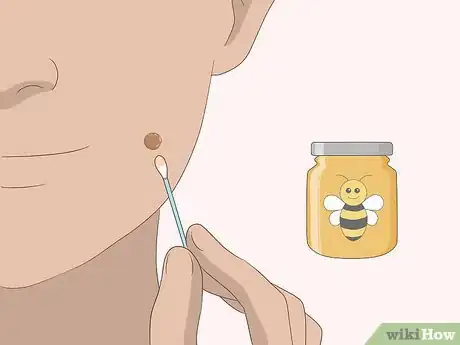 Image intitulée Remove Moles Quickly Step 15