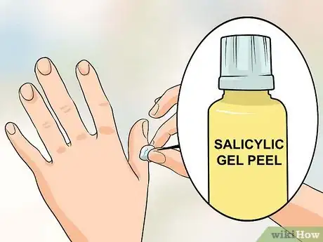 Image intitulée Get Rid of Warts on Fingers Step 1