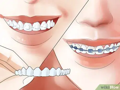 Image intitulée Determine if You Need Braces Step 18