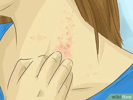 Image intitulée Stop Scratching Irritated Skin Step 17