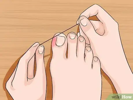 Image intitulée Relieve Ingrown Toe Nail Pain Step 8