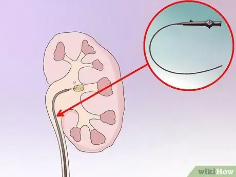 Image intitulée Dissolve Kidney Stones Step 10