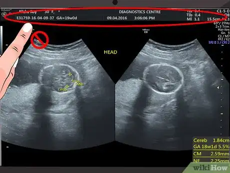 Image intitulée Read an Ultrasound Picture Step 1