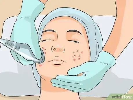 Image intitulée Control Rosacea Step 10