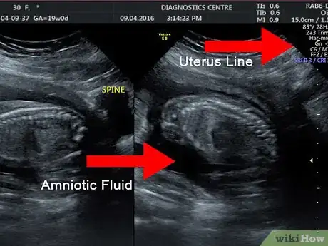 Image intitulée Read an Ultrasound Picture Step 5