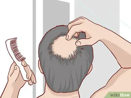 Image intitulée Know if You Have Male Pattern Baldness Step 6