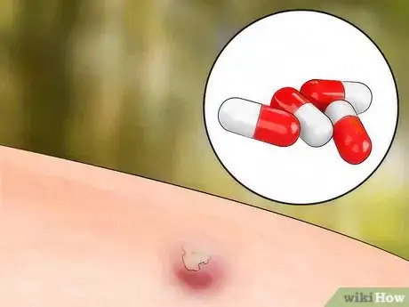 Image intitulée Get Rid of Bug Bites Step 27