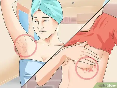 Image intitulée Diagnose Psoriasis Step 3