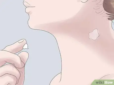 Image intitulée Get Rid of a Hickey Fast Step 5