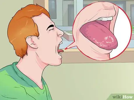 Image intitulée Treat Tongue Burn Blisters Step 6