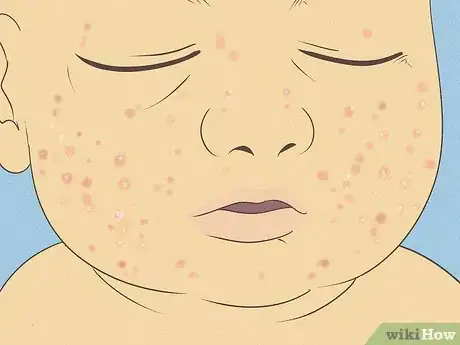 Image intitulée Know What to Expect on a Newborn's Skin Step 10