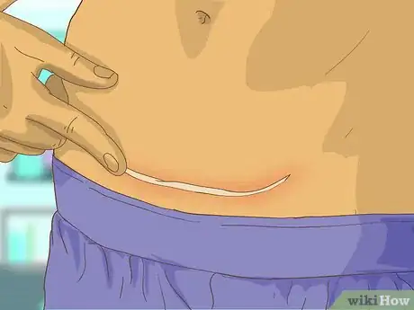 Image intitulée Care for Your C Section Scar Step 13