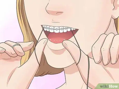 Image intitulée Make Your Braces Hurt Less Step 4