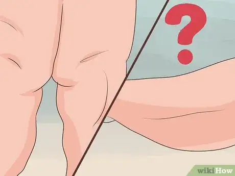 Image intitulée Diagnose Lipedema Step 8