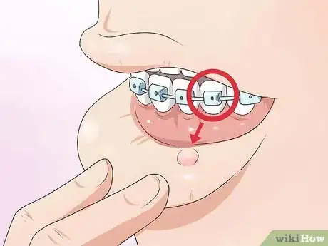 Image intitulée Make Your Braces Hurt Less Step 8