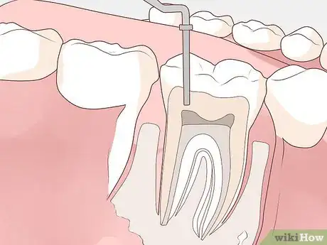 Image intitulée Get Rid of a Gum Boil Step 3