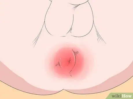 Image intitulée Prevent Perianal Abscess from Returning Step 14