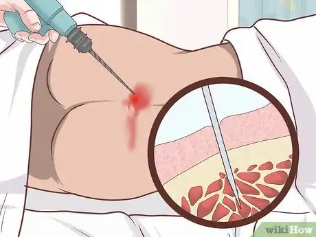 Image intitulée Diagnose Fanconi Anemia Step 17