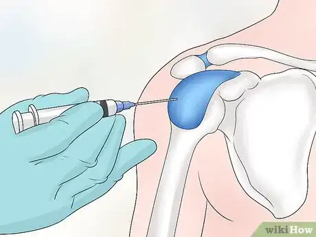 Image intitulée Treat Shoulder Tendonitis Step 15