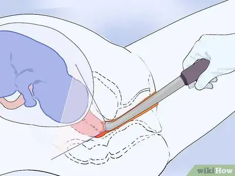 Image intitulée Prevent Incompetent Cervix Step 5