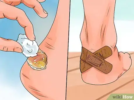 Image intitulée Heal Blisters Step 13