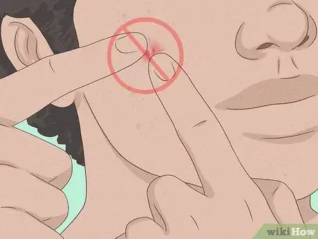 Image intitulée Get Rid of a Zit Overnight Step 16