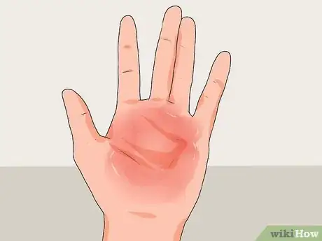 Image intitulée Treat a Hand Burn Step 10