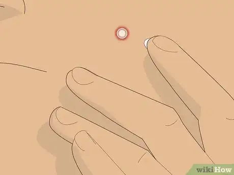 Image intitulée Get Rid of a Pimple Using Toothpaste Step 8