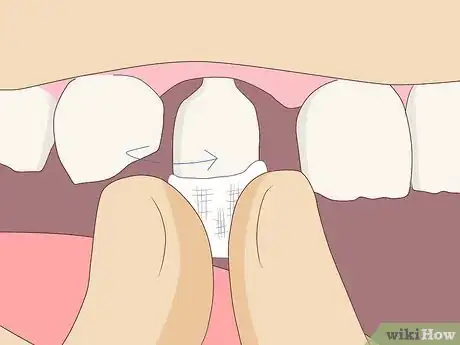 Image intitulée Pull Out a Tooth Without Pain Step 6